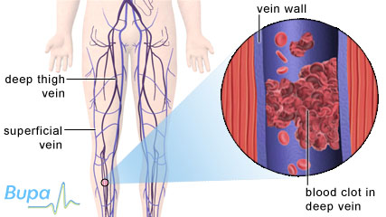 Illustration showing a blood clot in the deep vein of the calf which causes deep vein thrombosis