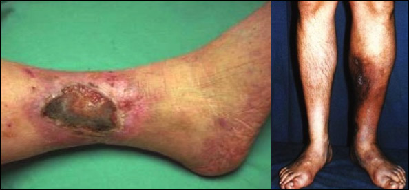 photos of patients with DVT