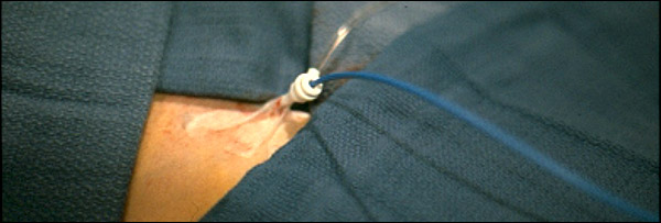 photo of small catheter incision